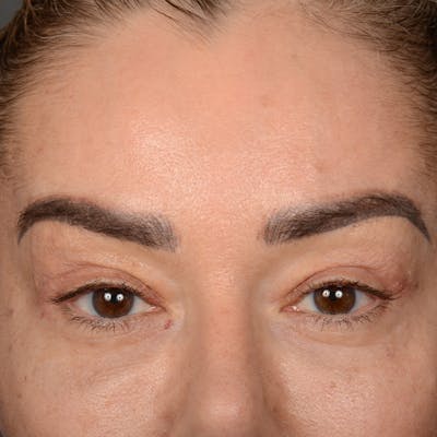 Eyelid Surgery Before & After Gallery - Patient 211894 - Image 2