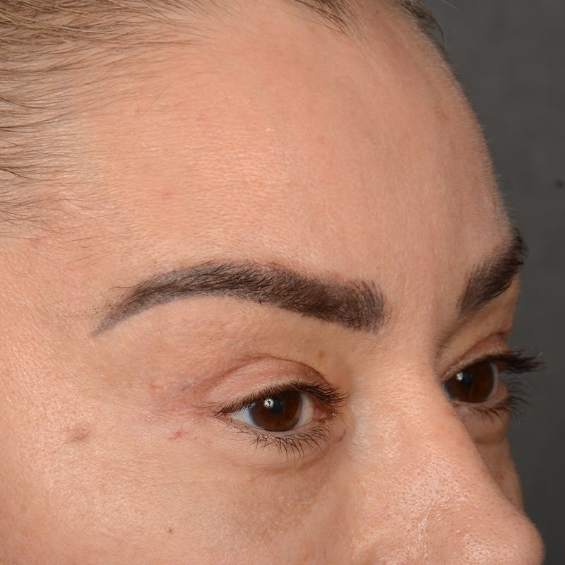 Eyelid Surgery Before & After Gallery - Patient 211894 - Image 4