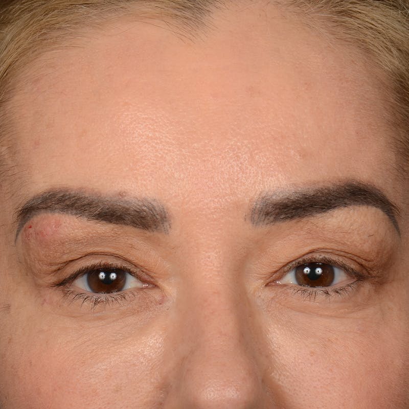Eyelid Surgery Before & After Gallery - Patient 211894 - Image 1