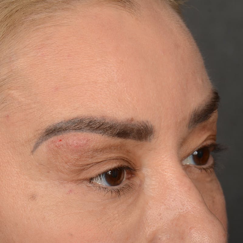 Eyelid Surgery Before & After Gallery - Patient 211894 - Image 3