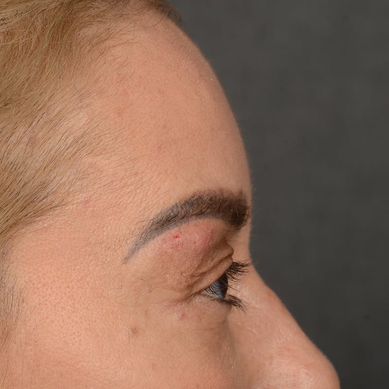 Eyelid Surgery Before & After Gallery - Patient 211894 - Image 5