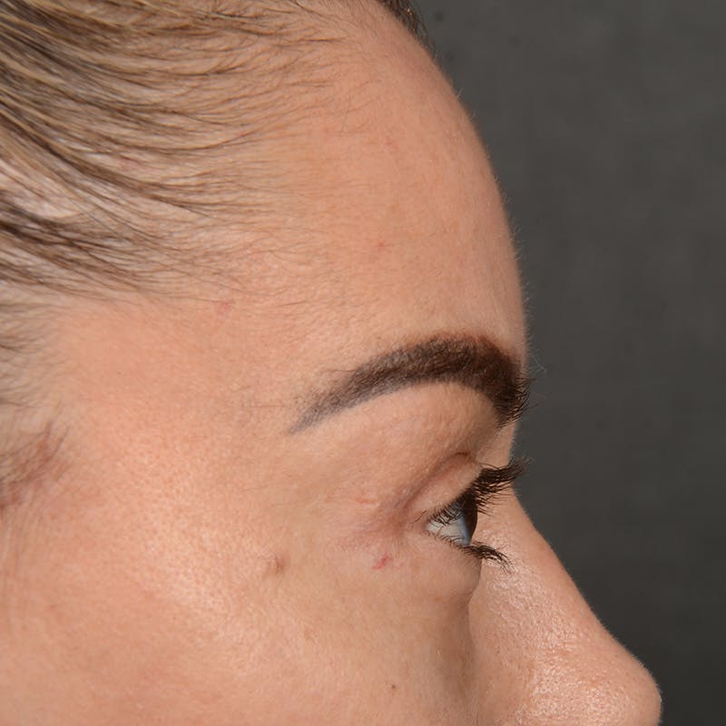 Eyelid Surgery Before & After Gallery - Patient 211894 - Image 6