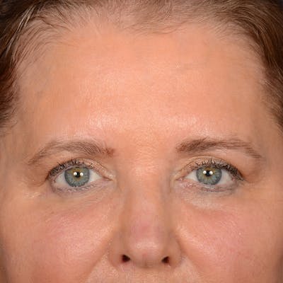 Eyelid Surgery Before & After Gallery - Patient 197803 - Image 1