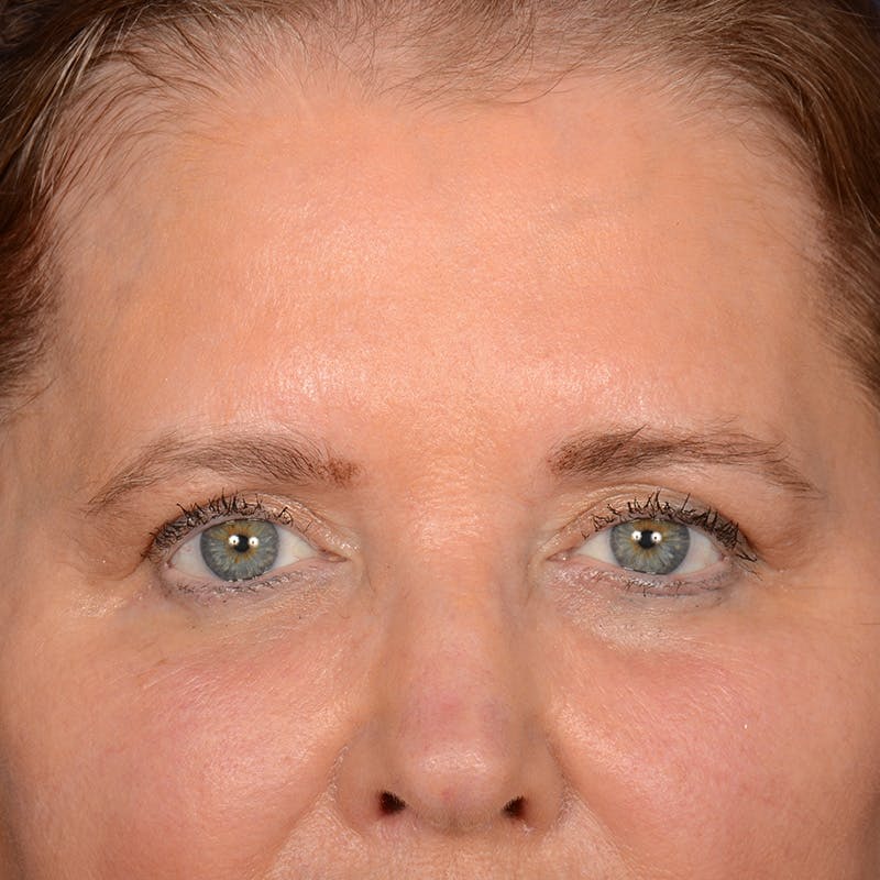 Eyelid Surgery Before & After Gallery - Patient 197803 - Image 1