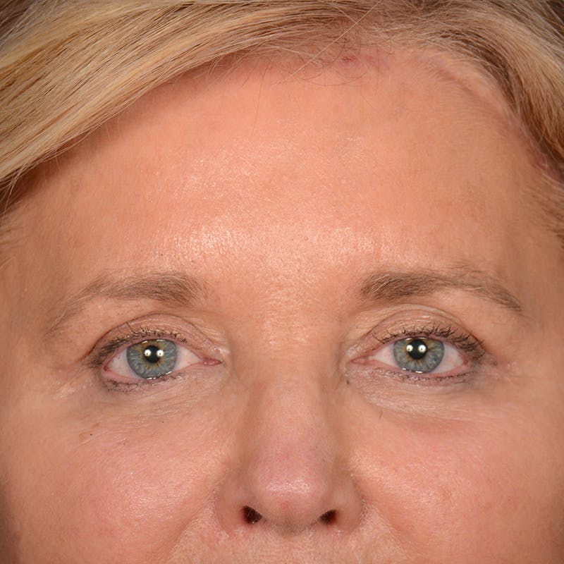 Eyelid Surgery Before & After Gallery - Patient 197803 - Image 2
