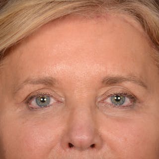 Eyelid Surgery Before & After Gallery - Patient 197803 - Image 2