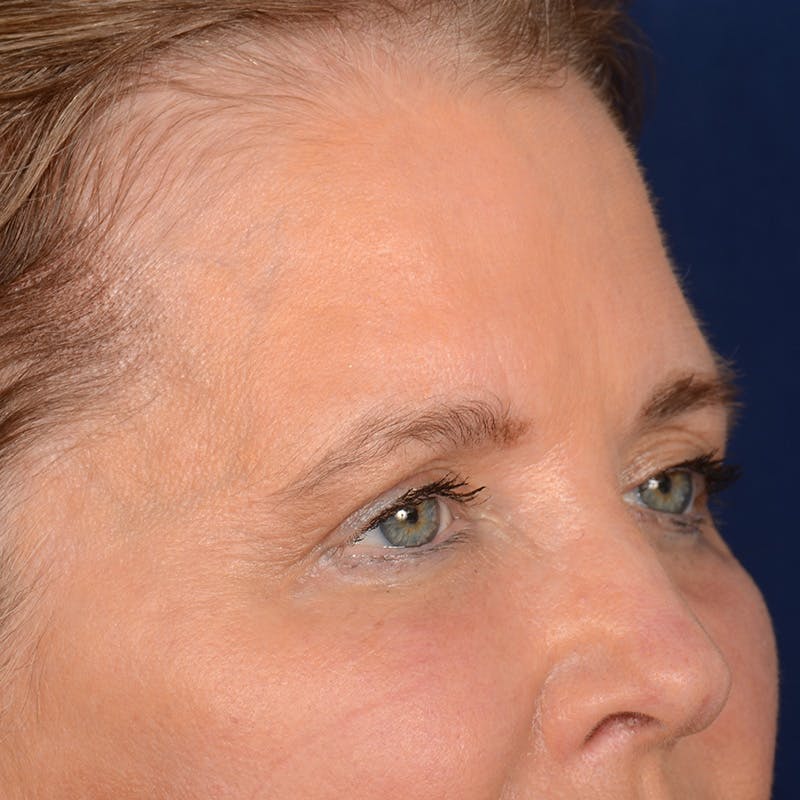 Eyelid Surgery Before & After Gallery - Patient 197803 - Image 3
