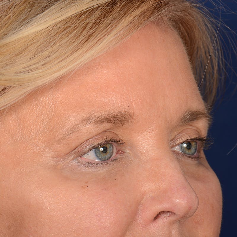 Eyelid Surgery Before & After Gallery - Patient 197803 - Image 4