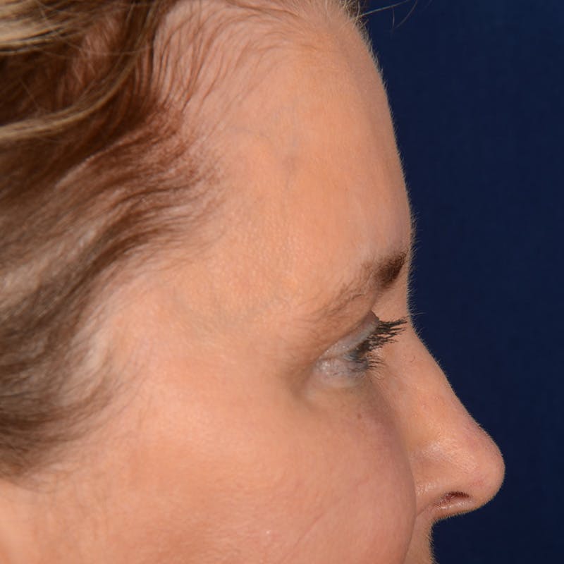 Eyelid Surgery Before & After Gallery - Patient 197803 - Image 5
