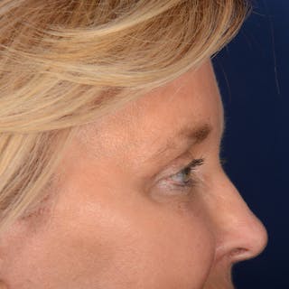 Eyelid Surgery Before & After Gallery - Patient 197803 - Image 6