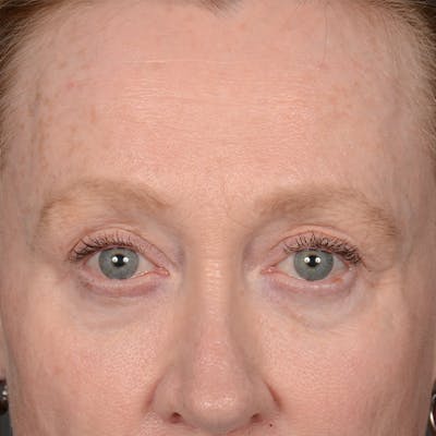 Eyelid Surgery Before & After Gallery - Patient 236015 - Image 1