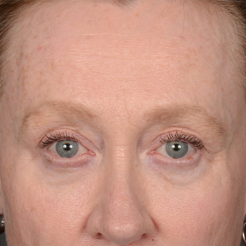 Eyelid Surgery Before & After Gallery - Patient 236015 - Image 1