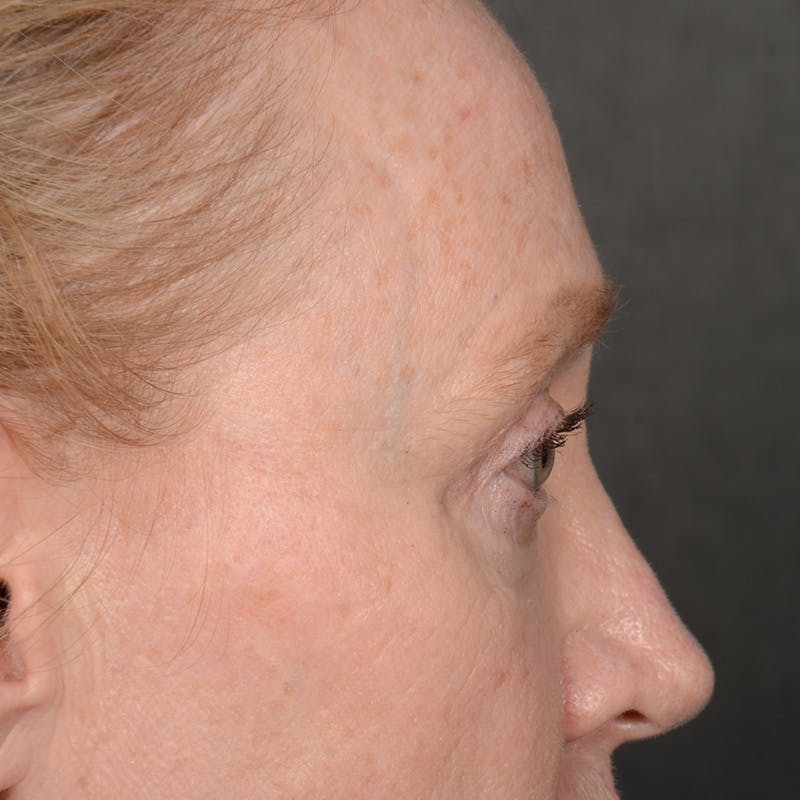 Eyelid Surgery Before & After Gallery - Patient 236015 - Image 5
