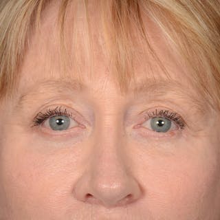 Eyelid Surgery Before & After Gallery - Patient 236015 - Image 2