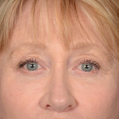 Eyelid Surgery Before & After Gallery - Patient 236015 - Image 2