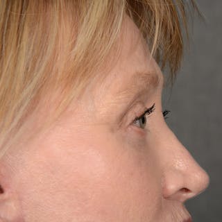 Eyelid Surgery Before & After Gallery - Patient 236015 - Image 6