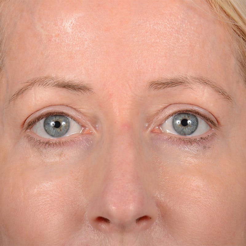 Eyelid Surgery Before & After Gallery - Patient 408730 - Image 1