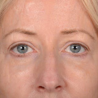 Eyelid Surgery Before & After Gallery - Patient 408730 - Image 2