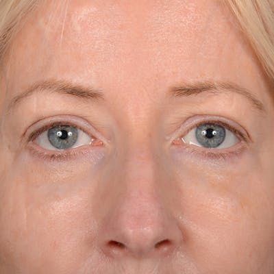 Eyelid Surgery Before & After Gallery - Patient 408730 - Image 2