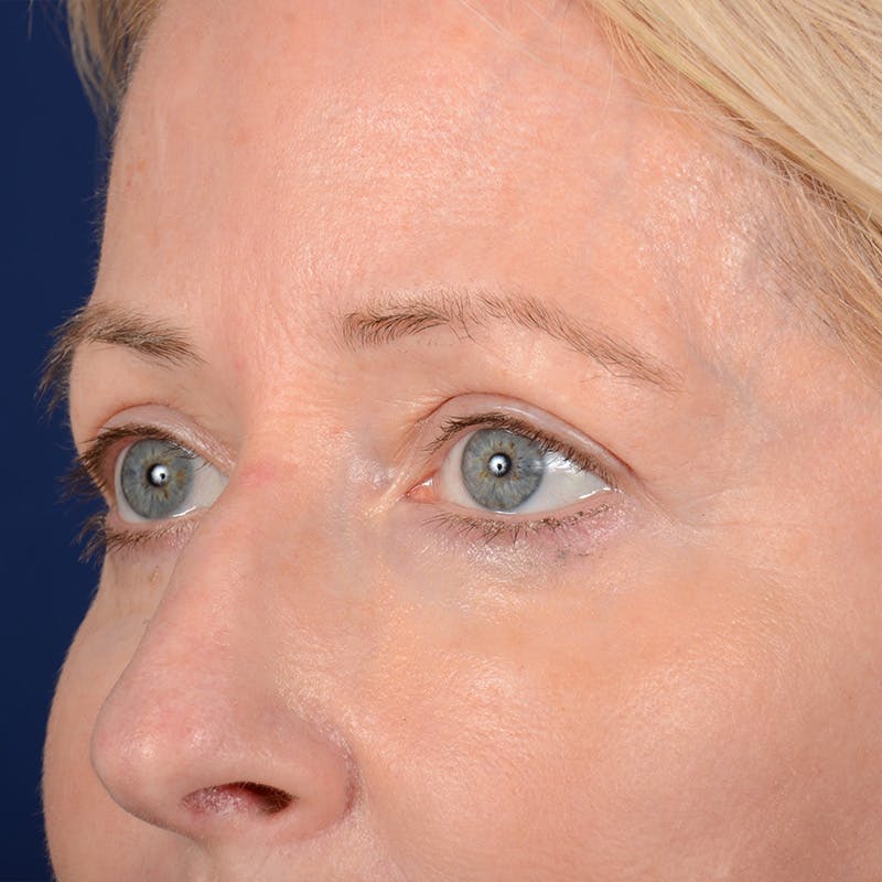 Eyelid Surgery Before & After Gallery - Patient 408730 - Image 3