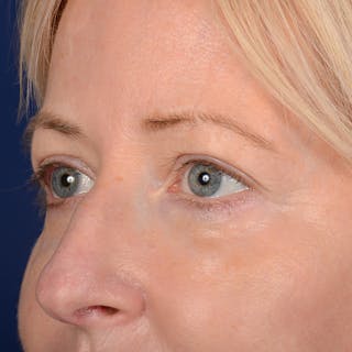 Eyelid Surgery Before & After Gallery - Patient 408730 - Image 4