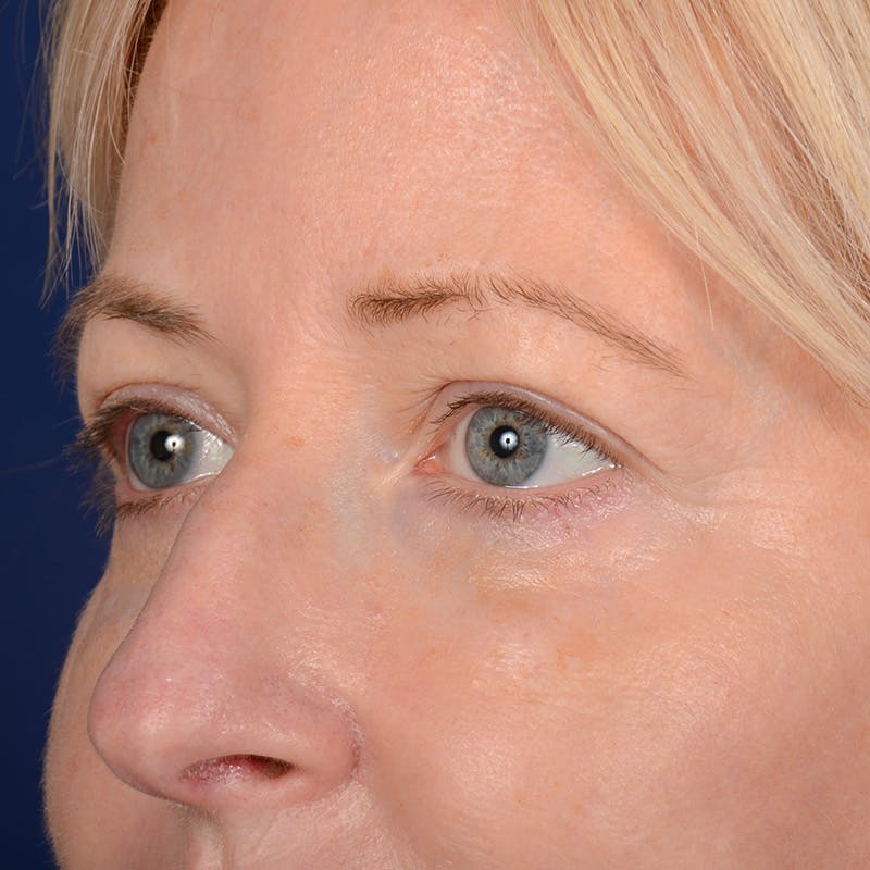 Eyelid Surgery Before & After Gallery - Patient 408730 - Image 4