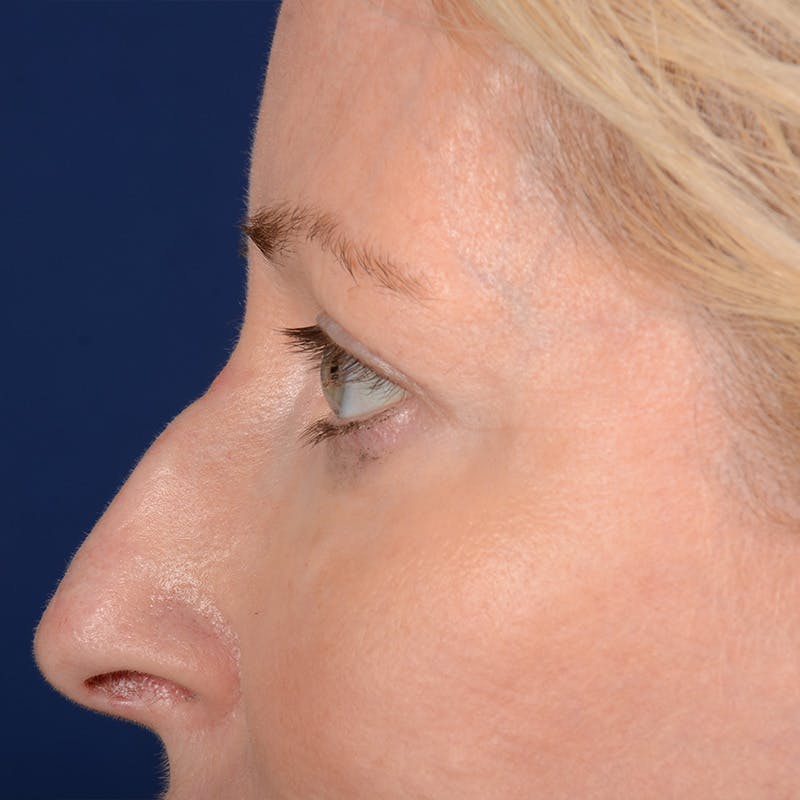 Eyelid Surgery Before & After Gallery - Patient 408730 - Image 5