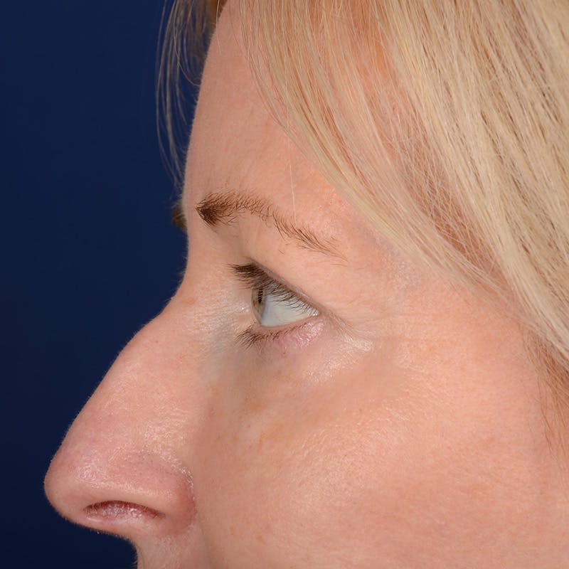 Eyelid Surgery Before & After Gallery - Patient 408730 - Image 6