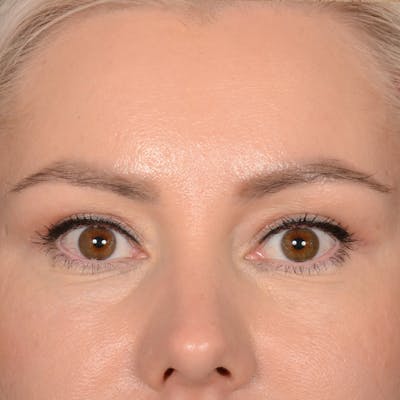 Eyelid Surgery Before & After Gallery - Patient 245336 - Image 1