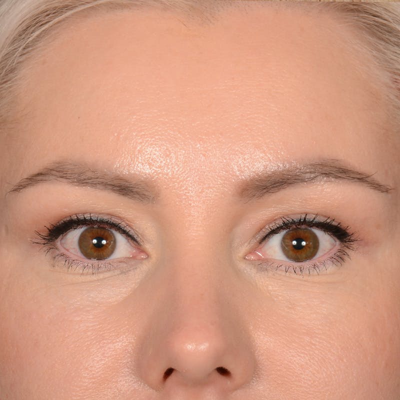 Eyelid Surgery Before & After Gallery - Patient 245336 - Image 1