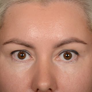 Eyelid Surgery Before & After Gallery - Patient 245336 - Image 2