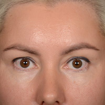 Eyelid Surgery Before & After Gallery - Patient 245336 - Image 2