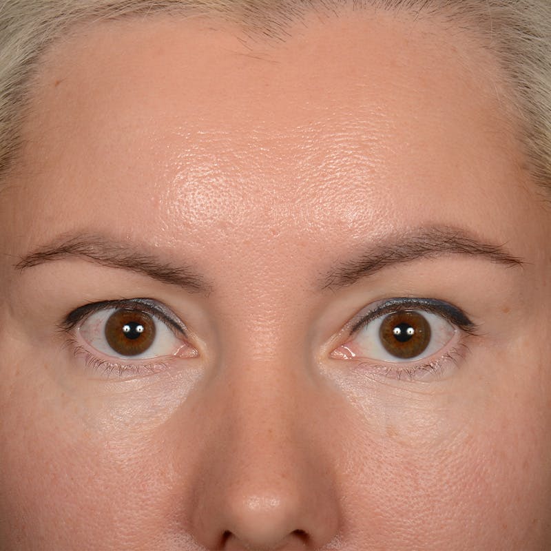 Eyelid Surgery Before & After Gallery - Patient 245336 - Image 2