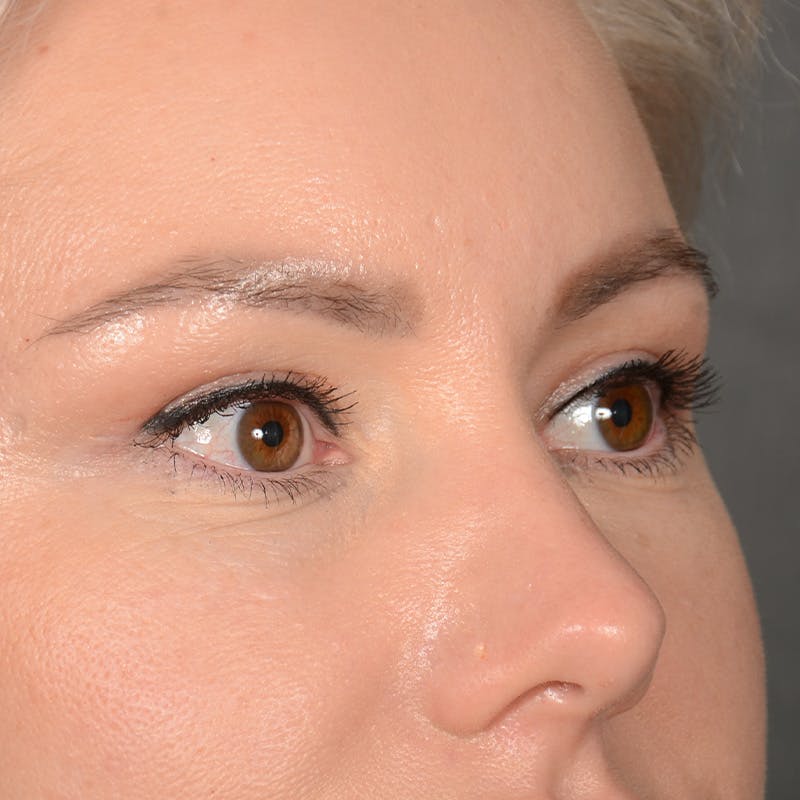 Eyelid Surgery Before & After Gallery - Patient 245336 - Image 3