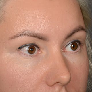 Eyelid Surgery Before & After Gallery - Patient 245336 - Image 4