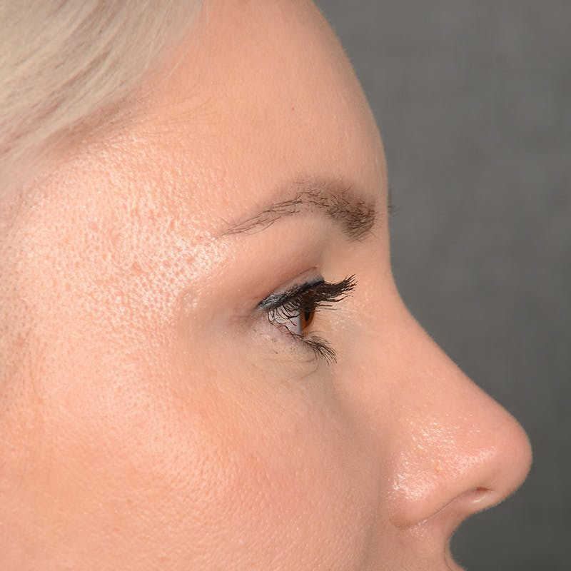 Eyelid Surgery Before & After Gallery - Patient 245336 - Image 5
