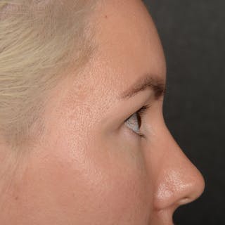 Eyelid Surgery Before & After Gallery - Patient 245336 - Image 6