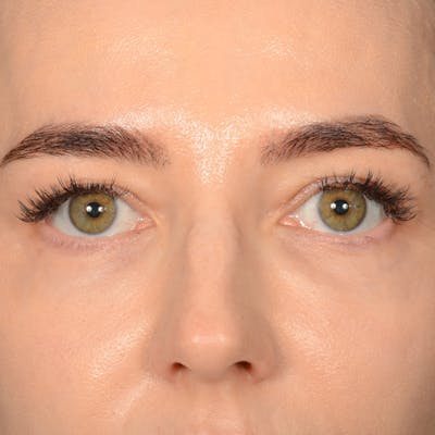 Eyelid Surgery Before & After Gallery - Patient 641563 - Image 1