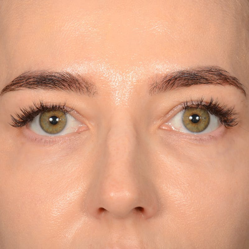 Eyelid Surgery Before & After Gallery - Patient 641563 - Image 1