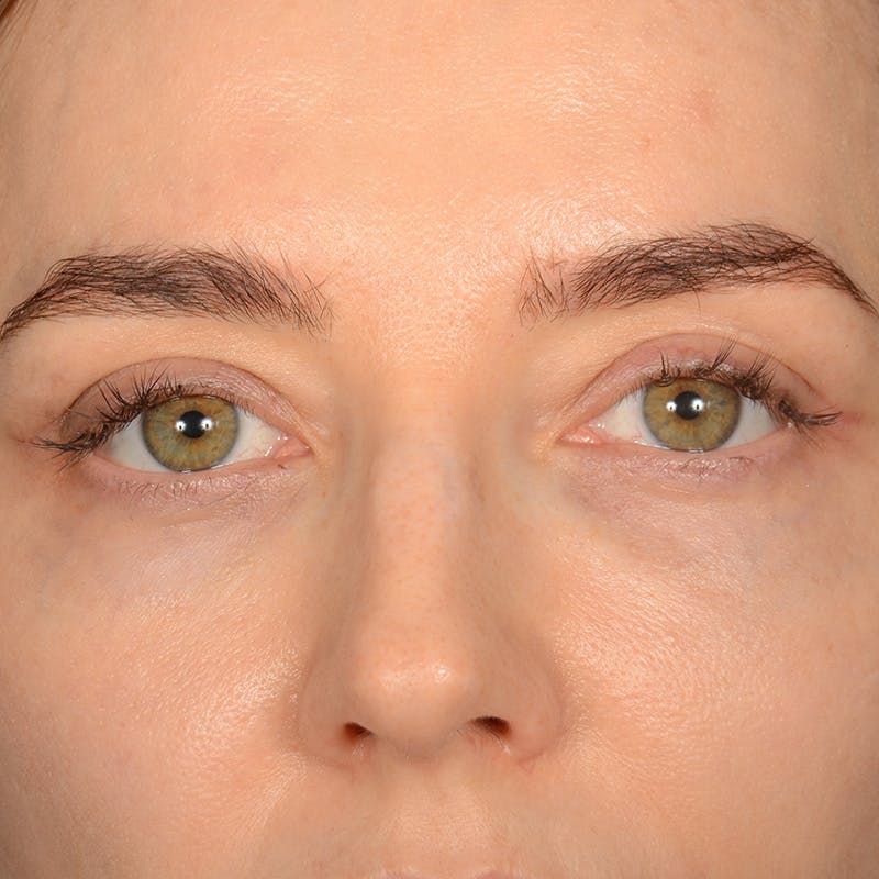 Eyelid Surgery Before & After Gallery - Patient 641563 - Image 2
