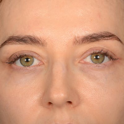 Eyelid Surgery Before & After Gallery - Patient 641563 - Image 2