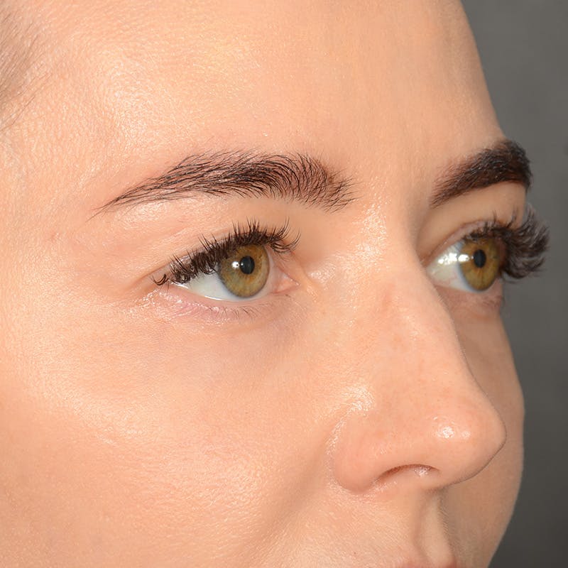 Eyelid Surgery Before & After Gallery - Patient 641563 - Image 3