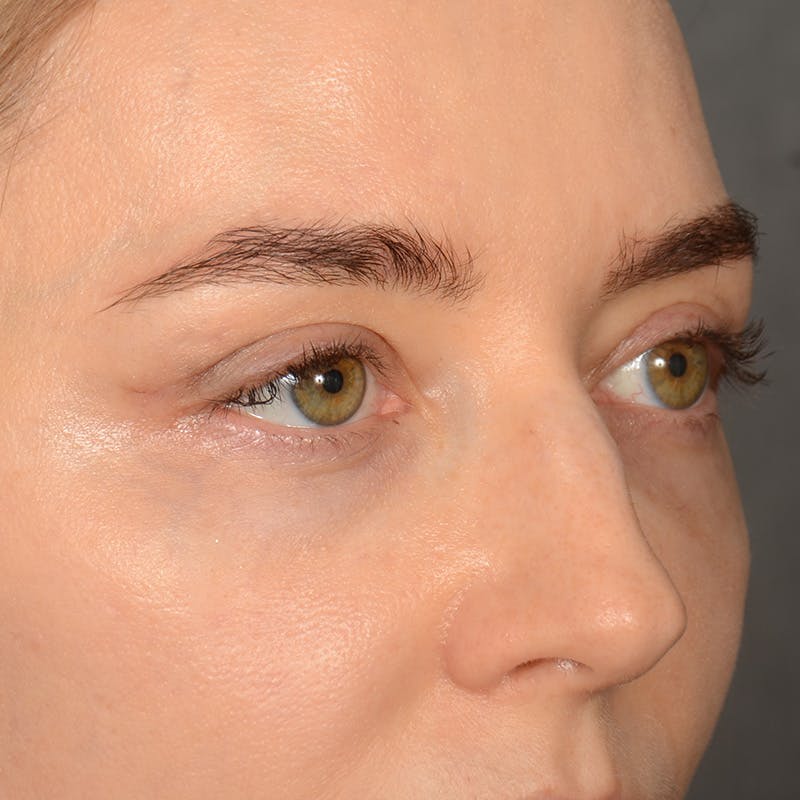 Eyelid Surgery Before & After Gallery - Patient 641563 - Image 4