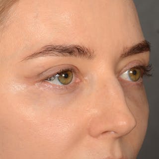 Eyelid Surgery Before & After Gallery - Patient 641563 - Image 4