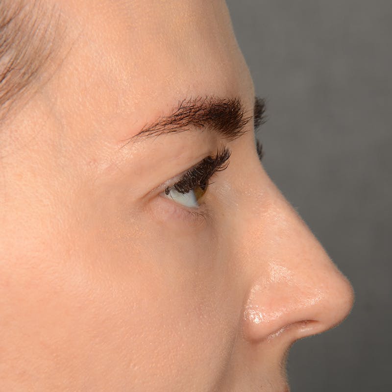 Eyelid Surgery Before & After Gallery - Patient 641563 - Image 5