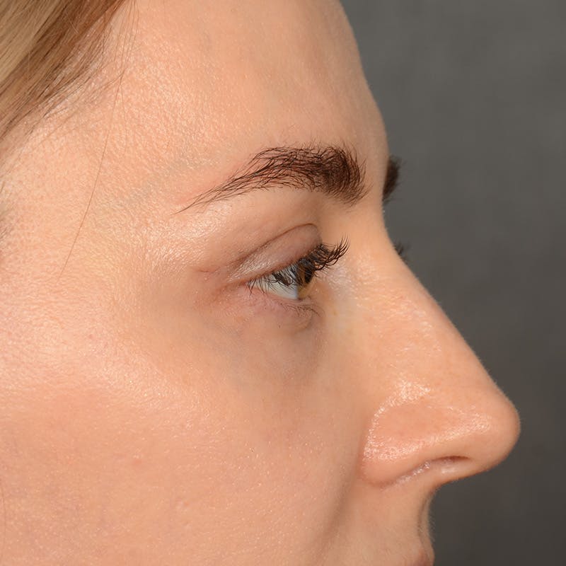 Eyelid Surgery Before & After Gallery - Patient 641563 - Image 6