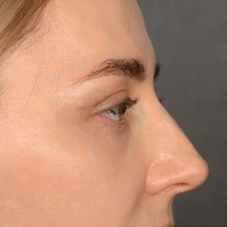 Eyelid Surgery Before & After Gallery - Patient 641563 - Image 6