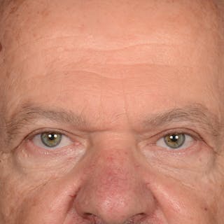 Eyelid Surgery Before & After Gallery - Patient 397663 - Image 2