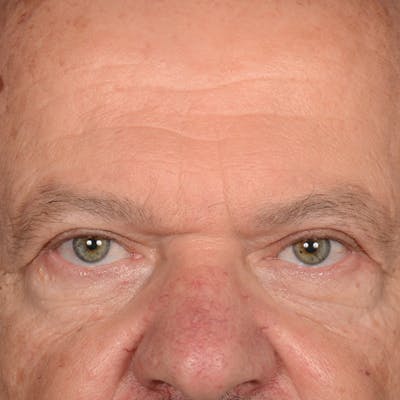 Eyelid Surgery Before & After Gallery - Patient 397663 - Image 2