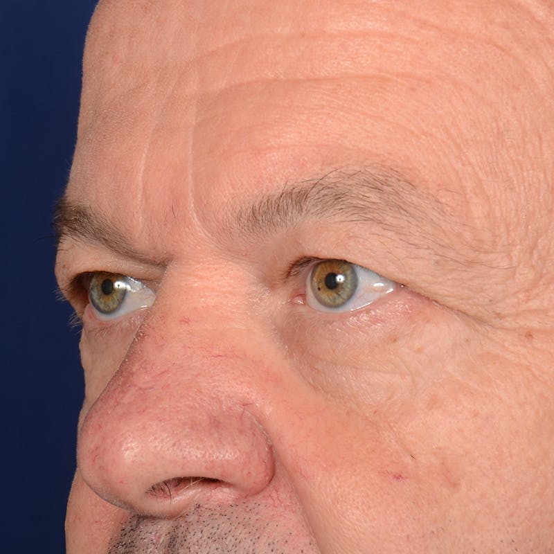 Eyelid Surgery Before & After Gallery - Patient 397663 - Image 3